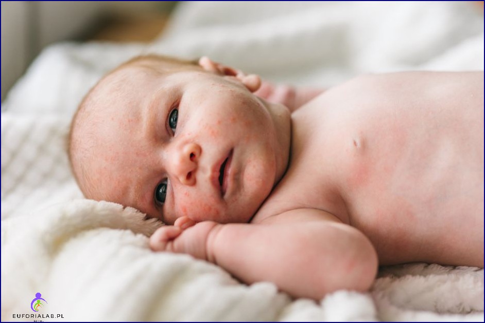 Napletek u dzieci i niemowląt objawy stulejki zapalenie napletka