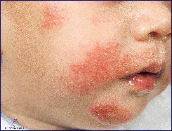 Ojotokowe zapalenie skóry u dzieci