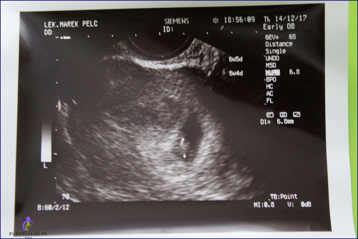 Pierwsze USG zrobiła dopiero w 41 tygodniu ciąży ponieważ nie wierzyła w medycynę To mogło