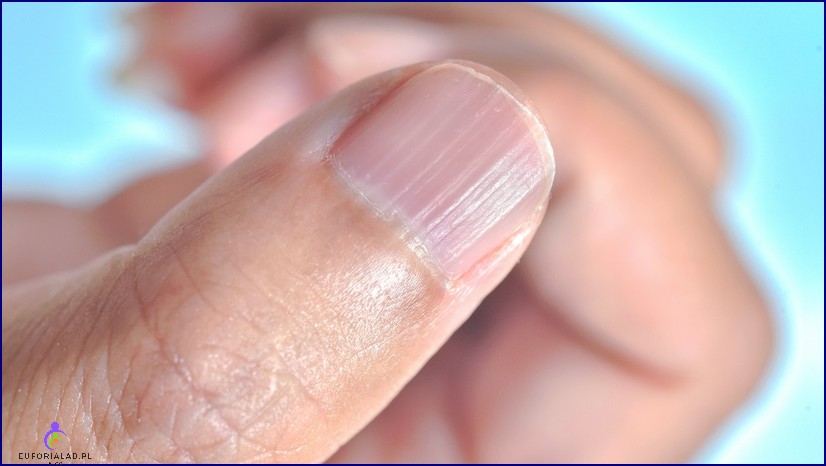 Pękające lub schodzące paznokcie u dziecka przyczyny leczenie